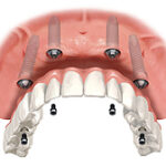 replace a denture with 4 dental implants