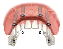 replace a denture with 4 dental implants