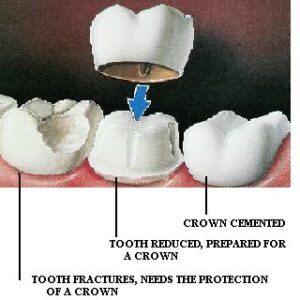 What are tooth crowns?