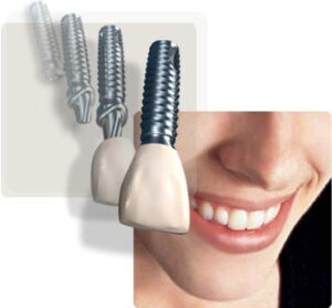 dental implants cheaper than UK