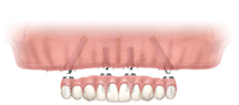 4 dental implants to the upper jaw