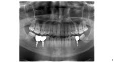 Otisi X-ray after his dental treatment