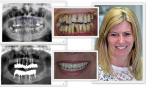 before & after dental treatment abroad