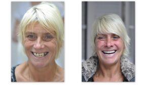 Before dental treatment and picture of client with temporary bridge.