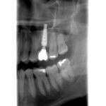 X-ray of Charles implant
