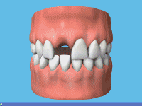 dental-implant-placement