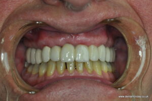 12 unit ceramic bridge fitted on 5 dental implants