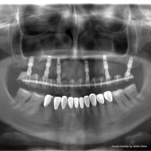 Dental X-ray taken after implant treatment