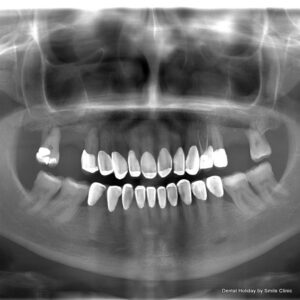 Dental Xray taken before Dental implant surgery