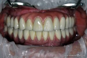 14-point dental bridge fit to 6 dental implants on both jaws