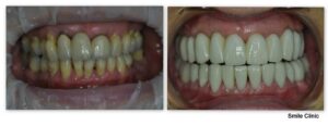 Pamela´s smile before the treatment and after the treatment