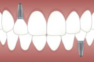 picture of Dental implants 