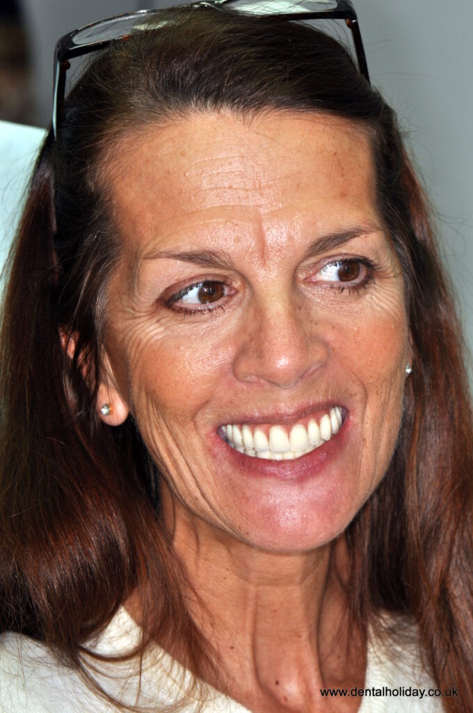 Wendy with her new teeth