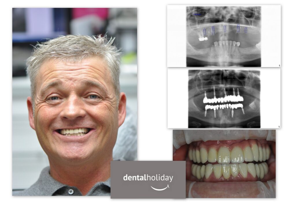 no more dentures
