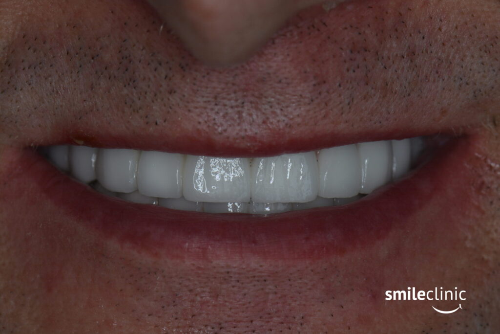 Patient´s brand new smile with dental implants and dental crowns