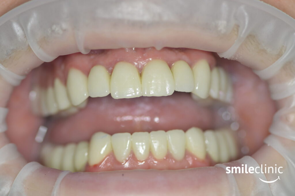 Lukas after the treatment with Smile Clinic